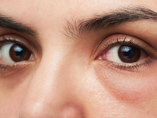 روش هایی موثر برای از بین بردن پف چشم